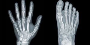 Osteopenia Stem Cell Treatment Services