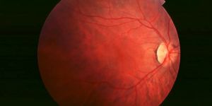 Retinitis Pigmentosa Stem Cell Treatment Services