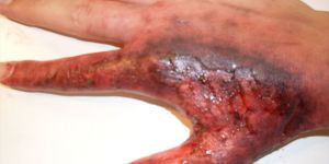 Skin Burns Stem Cell Treatment Services