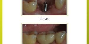Dental Implant Restoration