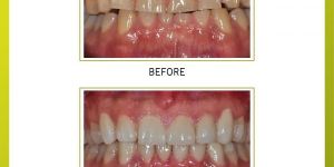 Full Mouth Restoration