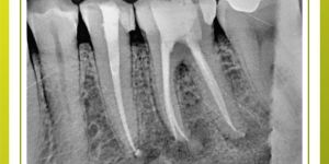 Root Canal Treatment