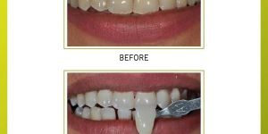 Teeth Whitening