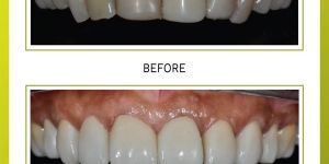 Veneers Treatment