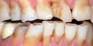 Bruxism Treatment in Ahmedabad