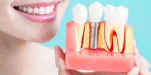 Dental Implant