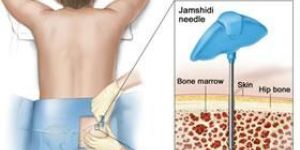 Acute Lymphocytic Leukemia Treatment (Adult)