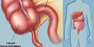 Appendix Cancer Treatment