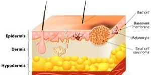 Basal Cell Carcinoma Treatment
