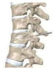 Vertebroplasty Therapy Service