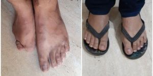 Silicone Foot Prosthesis