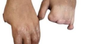 Silicone Hand Prosthesis