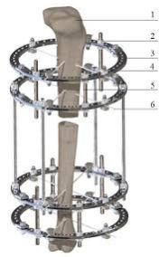 ILizarov External Fixator