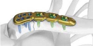 Orthopedic Locking Plate