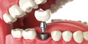 Dental Implant