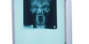 X Ray Screen
