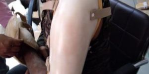 Humeral Fracture Braces