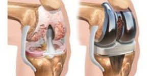 Knee Replacement Treatment