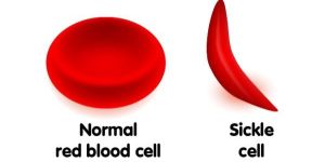 Sickle Cell Anemia Treatment
