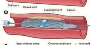 Stent Treatment