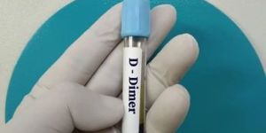 D Dimer Test