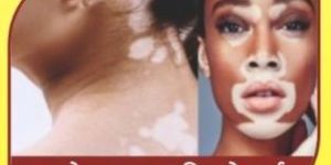 Leucoderma Ayurvedic Treatment