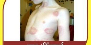 Ringworm Ayurvedic Treatment