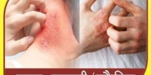 Scabies Ayurvedic Treatment