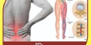 Sciatica Ayurvedic Treatment