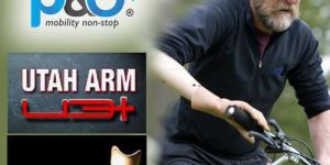 Arm Prostheses