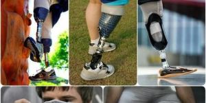 Artificial Limbs