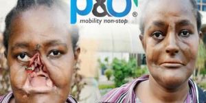 Silicone Ear Prosthesis