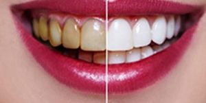 Teeth Whitening