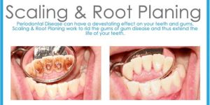 Teeth Scaling Services