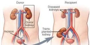 Kidney Transplant Services