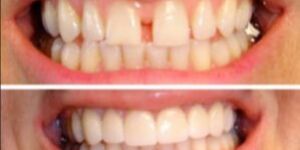 Cosmetic Dental Treatment
