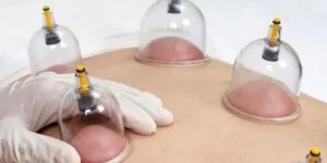 Cupping Therapy