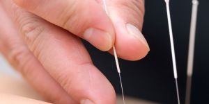 Needling Acupuncture Therapy