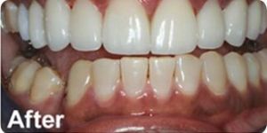 Ceramic Veneers
