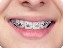 Metal Braces