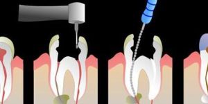 Single Visit Treatment