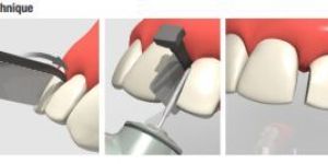 DIRECTA FENDERWEDGE PREP DENTAL WEDGE