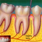 Gum (Periodontal) Diseases