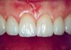 Porcelain Veneers