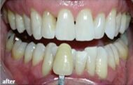 Teeth Whitening