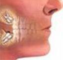 Wisdom Teeth