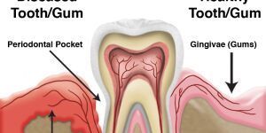 Complete Gum Treatment