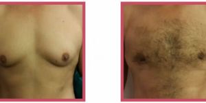 Gynaecomastia Treatment Services