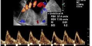 Uterine Artery Doppler Scans