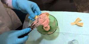 Alginate Impression Material
